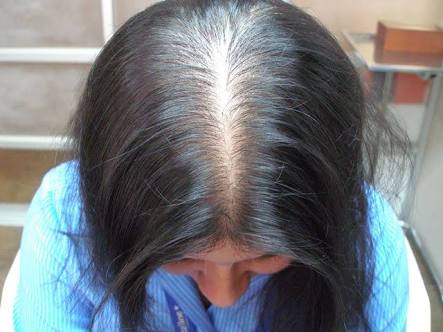 Alopecia Femenina